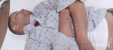 धमतरी: भटगांव शराब भट्टी के पास पत्थर से टकराकर गिरने से स्कूटी सवार 2 युवक हुए घायल