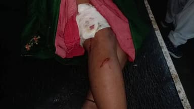 कटंगी: नहलेसरा में खेत में तुअर तोड़ रही महिला पर जंगली सूअर का हमला