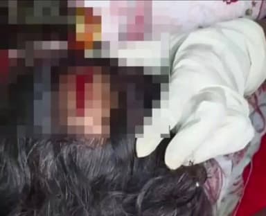 గద్వాల్: కోతులతో దాడిలో చిన్నారికి తీవ్ర గాయాలు