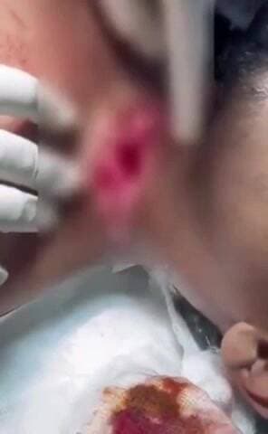 మేడ్చల్: కీసరలో చైనా మాంజ మెడకు తగిలి యువకుడికి తీవ్ర గాయాలు