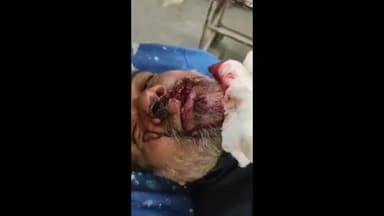 लाडपुरा: कोटा शहर के पाटनपोल में आवारा कुत्तों ने ऑटो चालक पर किया हमला, चेहरे पर गंभीर घाव