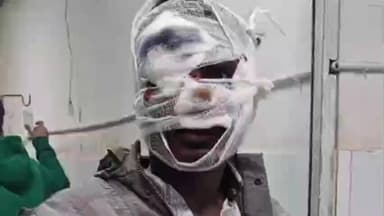 डंडा: नीलगाय को बचाने की कोशिश में बाइक सवार गंभीर रूप से घायल, मेदिनीनगर में इलाज जारी