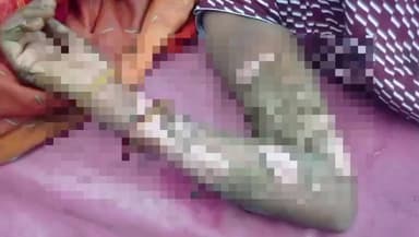 नुआंव: चौरसिया में आग तापने के दौरान महिला के कपड़े में लगी आग, महिला झुलसी और सदर अस्पताल रेफर