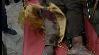 लोहरदगा: पतगच्छा में बोरिंग के दौरान ट्रैक्टर से युवक का हाथ कटा, हालत गंभीर