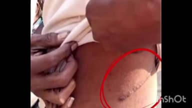 नागभिर: रोशन कुडे किडनी विक्री प्रकरणात त्या सहाही अवैद्य सावकाराचा जमानत अर्ज न्यायालयाने फेटाळला