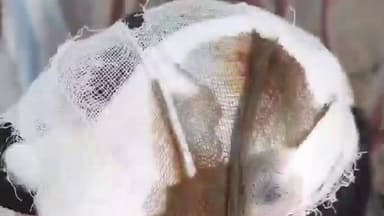 बलिया: लखमिनिया कुर्मी टोल में बच्चों के विवाद में एक बच्चे के साथ मारपीट, सिर फोड़ा