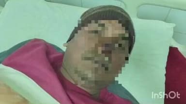 बहराइच: सलारपुर में खूंखार आवारा कुत्ते का आतंक, युवक की नाक और पैर को नोचकर किया घायल