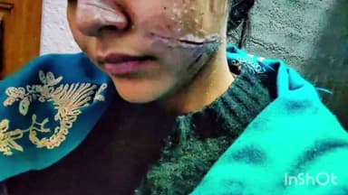 दूनी: देवली में चाइनिज मांझे से बालिका गंभीर घायल, तस्वीरें देखकर हो जाएंगे आक्रोशित