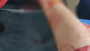 देवास: पुराना बस स्टैंड क्षेत्र में चाइनीस धागे से बुजुर्ग का पैर कटा, जिला अस्पताल में उपचार जारी