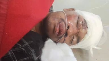 चाईबासा: चिटीमिटी गांव में मोटरसाइकिल की टक्कर से एक अज्ञात युवक जख्मी, सदर अस्पताल में इलाज जारी