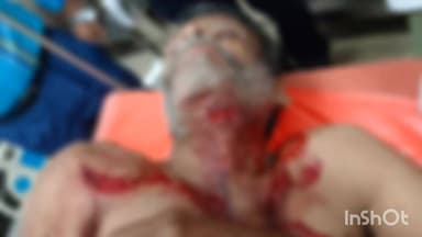 ಶಿಕಾರಿಪುರ: ಹಾರೋಗೊಪ್ಪ ಗ್ರಾಮದಲ್ಲಿ ಕರಡಿ ದಾಳಿ:ವ್ಯಕ್ತಿ ಗಂಭೀರ