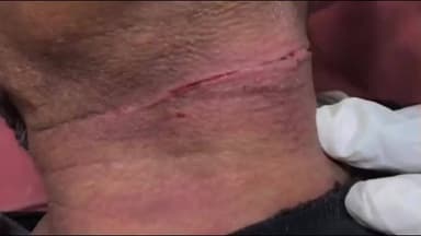 जौनपुर: चाइनीज मांझे की चपेट में आए पूर्व शासकीय अधिवक्ता, गले पर गंभीर घाव हुआ