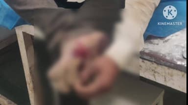 भंडारा: सुरेवाडा उड्डाणपुलावर दुचाकीचा अपघात; डिव्हायडरला धडक लागल्याने मांडवी येथील दुचाकीस्वार जखमी