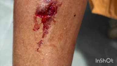 यवतमाळ: वडगाव रोड परिसरात मोकाट कुत्र्यांच्या वाढत्या हल्ल्यामुळे नागरिकांमध्ये भीतीचे वातावरण, तात्काळ बंदोबस्त करण्याची मागणी