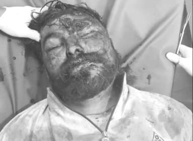 सुठालिया: सुठालिया के पास हिजड़ा महाराज में नल खोलने पर खूनी संघर्ष, एक घायल, तीन पर मामला दर्ज