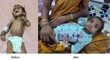 #खुशियों_की_दास्तां
15 दिन की देखभाल से मुस्कुराया बचपन
पोषण पुनर्वास केंद्र ने छिंदवाड़ा जिले की हर्रई तहसील के ग्रा...