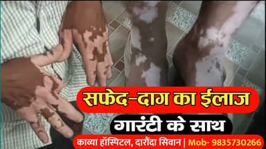 चास: सिवान जिले के काव्या सेवा सदन में सफेद दाग का गारंटी के साथ हो रहा है ईलाज, दवा का असर नहीं तो पैसा वापस | 9835730266