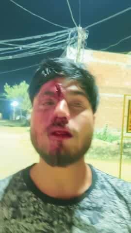 अपने और दूसरे विपक्षी के झगड़ा सुलझाने में विपक्षी ने डंडे व लाठी से मार पीट कर सर फाड़ दिया ...थाना राबर्ट्सगंज सोनभद्र