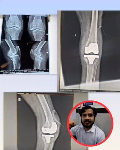 छतरपुर डॉक्टर रवि सोनी ने किया बुजुर्ग व्यक्ति के घुटने की सफल सर्जरी ,5 साल से था बुजुर्ग परेशान, लाखो रुपए होते है खर्...