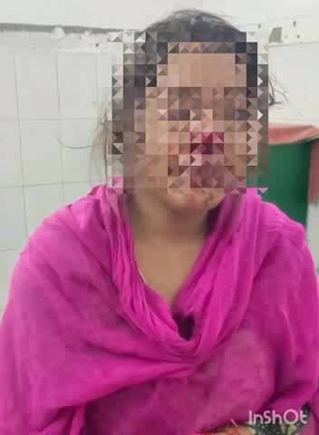 कैसरगंज: जरवल रोड इलाके में पति ने पत्नी की नाक दांत से काटी, गंभीर हालत में जिला अस्पताल किया गया रेफर