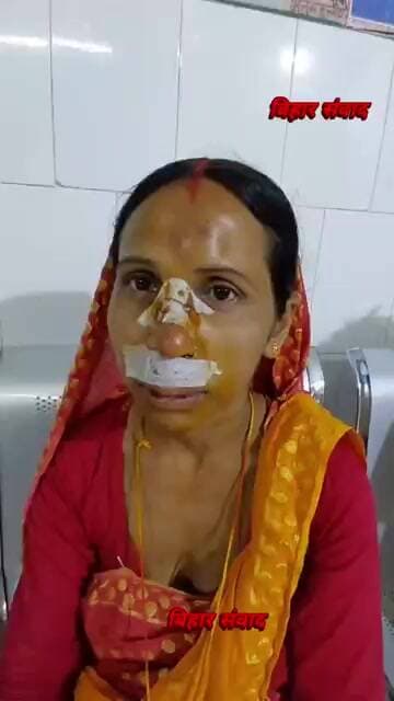 नवगछिया में दिनदहाड़े चेन स्नेचिंग महिला को धक्का देकर बदमाशों ने छीनी सोनेकी चेन चेहरे पर गंभीर चोट