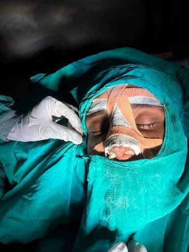 मंदसौर में नाक की ट्रॉमा सर्जरी की सफल शुरुआत
सुंदरलाल पटवा शासकीय मेडिकल कॉलेज एवं इंदिरा गांधी चिकित्सालय, मंदसौर के नाक-कान-गला (ईएनटी) विभाग में नाक की ट्रॉमा सर्जरी की सफल शुरुआत की गई।
यह सर्जरी ईएनटी विभाग की असिस्टेंट प्रोफेसर डॉ. कश्मीरा कुमावत, सीनियर रेसिडेंट डॉ. जिज्ञासा बारोड़ एवं सीनियर रेसिडेंट डॉ. हिमांशु परमार द्वारा सफलतापूर्वक संपन्न की गई।
सुंदरलाल पटवा शासकीय मेडिकल कॉलेज की डीन डॉ. शशि गांधी के मार्गदर्शन एवं प्रोत्साहन में यह जटिल शल्य चिकित्सा सफलतापूर्वक संपन्न हो सकी। साथ ही ईएनटी विभाग के डॉ. लवी उकावत का भी सहयोग प्राप्त हुआ।
मरीज 22 वर्षीय युवक था, जिसे पॉलीट्रॉमा के कारण नाक में गंभीर चोट आई थी। जांच में नाक की हड्डी (नेज़ल बोन) तथा सेप्टल कार्टिलेज में फ्रैक्चर पाया गया। विशेषज्ञ चिकित्सकों द्वारा विस्तृत प्री-ऑपरेटिव योजना एवं सावधानीपूर्वक मूल्यांकन के पश्चात मरीज की क्लोज्ड रिडक्शन ऑफ नेज़ल फ्रैक्चर सर्जरी सफलतापूर्वक की गई। सर्जरी के उपरांत नाक में आवश्यक पैकिंग एवं स्प्लिंट लगाया गया।
वर्तमान में मरीज पूर्णतः स्वस्थ है तथा उसकी स्थिति संतोषजनक है। इस सफल सर्जरी के साथ मेडिकल कॉलेज एवं चिकित्सालय में नाक की ट्रॉमा सर्जरी सेवाओं का शुभारंभ हुआ है, जिससे क्षेत्र के मरीजों को उन्नत ईएनटी उपचार स्थानीय स्तर पर उपलब्ध हो सकेगा। यह उपलब्धि संस्थान में विशेषज्ञ चिकित्सा सेवाओं के विस्तार की दिशा में एक महत्वपूर्ण कदम मानी जा रही है।
#Mandsaur
#मंदसौर