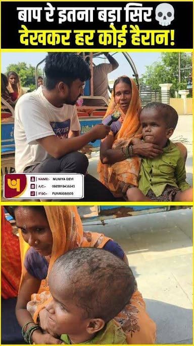 बाप रे इतना बड़ा सिर 😱देखकर हर कोई हैरान!#Hydrocephalus #RareDisease #ChildHealth #MedicalCase #ViralPhoto #Humanity #HelpNeeded #Awareness #Trending #InspiringStory #India #HealthAwareness #Support #NewsUpdate #ViralNews