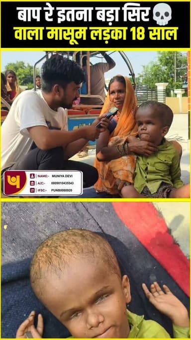 बाप रे इतना बड़ा सिर💀वाला मासूम लड़का 18 साल !!😱!! #viralphoto #hydrocephalus #NewsUpdate #humanity #viralnews #support #trending #ChildHealth #india #awareness