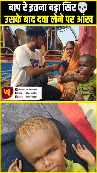 बाप रे इतना बड़ा सिर💀उसके बाद दवा लेने पर आंख !!😱!! #viralphoto #hydrocephalus #NewsUpdate #humanity #india #viralnews #trending