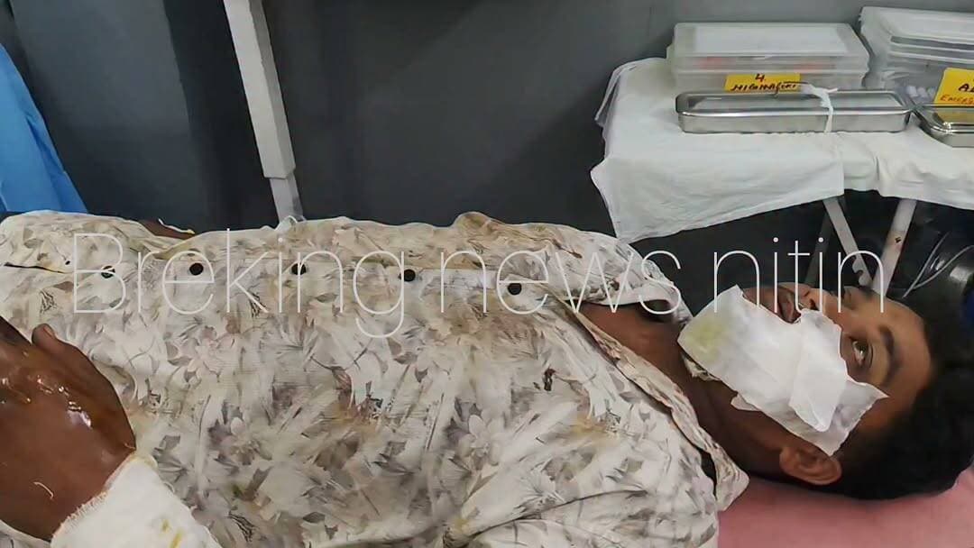 🚨 झल्लार स्वास्थ्य केंद्र की बड़ी लापरवाही! 🚨
बैतूल जिले के जामनिया-अमूरी मार्ग पर खराब सड़क के कारण हुए बाइक हादसे में झल्लार निवासी 22 वर्षीय मुकेश (पिता मुन्ना) गंभीर रूप से घायल हो गए। चेहरे और हाथों पर गहरी चोटें आने के बाद उन्हें झल्लार सामुदायिक स्वास्थ्य केंद्र ले जाया गया।
परिजनों का आरोप है कि युवक के घावों में भरी मिट्टी और कंकड़ तक ठीक से साफ नहीं किए गए, सिर्फ मलहम लगाकर ड्रेसिंग की गई और फिर गंभीर हालत में जिला अस्पताल रेफर कर दिया गया। देर रात करीब 11 बजे उन्हें जिला चिकित्सालय पहुंचाया गया, जहां उनका इलाज जारी है।
❓ आखिर गंभीर घायल को प्राथमिक उपचार दिए बिना रेफर क्यों किया गया?
❓ क्या स्वास्थ्य केंद्र में इलाज की पर्याप्त व्यवस्था नहीं थी?
❓ खराब सड़क और स्वास्थ्य सेवाओं की इस दोहरी मार का जिम्मेदार कौन?
यदि आरोप सही हैं, तो यह मामला स्वास्थ्य व्यवस्था और सड़क सुरक्षा दोनों पर गंभीर सवाल खड़े करता है। प्रशासन को निष्पक्ष जांच कर दोषियों पर उचित कार्रवाई करनी चाहिए।
#झल्लार #बैतूल #Jhallar #Betul #सामुदायिकस्वास्थ्यकेंद्र #स्वास्थ्यव्यवस्था #MedicalNegligence #लापरवाही #सड़कहादसा #RoadAccident #जिला_अस्पताल #मध्यप्रदेश #MPNews #BetulNews #जनता_पूछ_रही_है #JusticeForMukesh #BreakingNews #ViralNews #TrendingNow