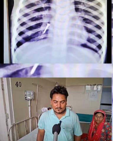 रोहतक नारनौल में तीन साल के बच्चे ने निगला पेच,परिजनों को एक साल बाद चला पता,पीजीआई में सफल ऑपरेशन #rohtakmdu #rohtakpolice #PGIMS