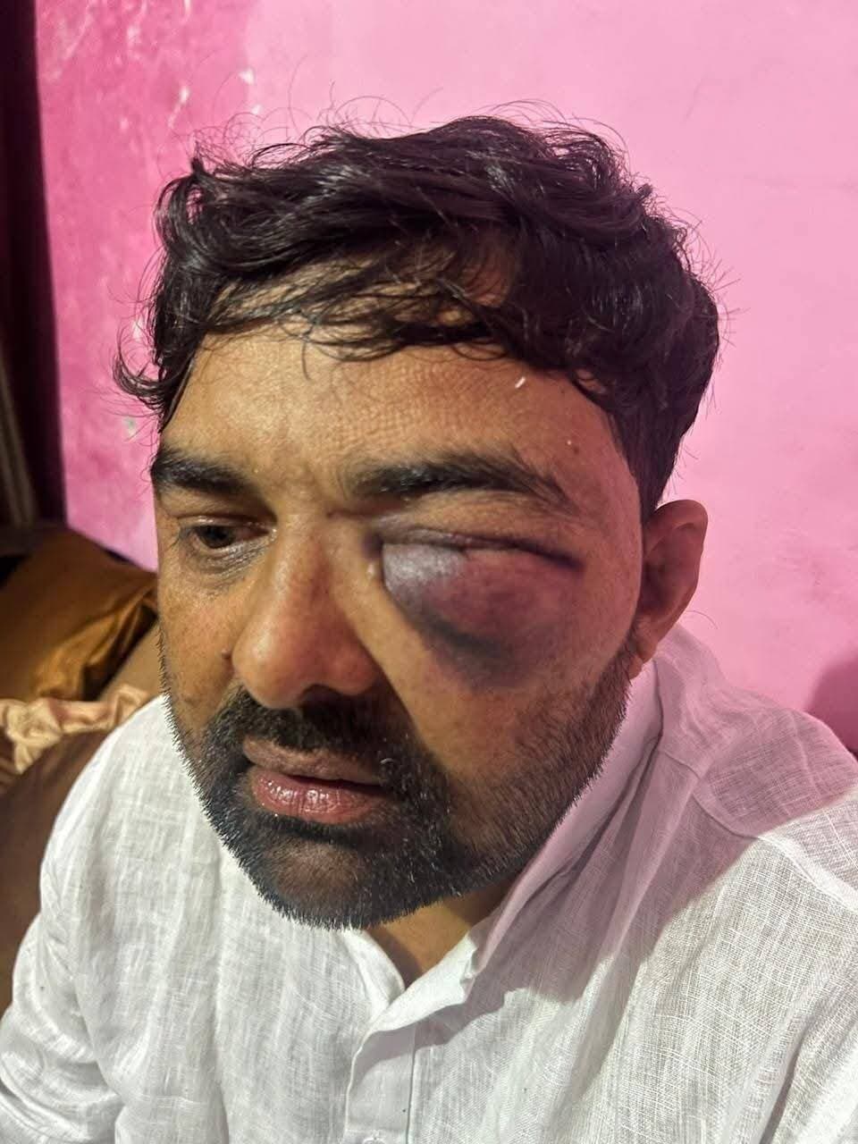 🚨 मेरठ में पुलिस हिरासत में कथित बर्बरता पर गंभीर सवाल
मेरठ में मोहित जाटव और दिग्विजय भाटी के साथ पुलिस हिरासत में कथित मारपीट और यातना के आरोप बेहद गंभीर हैं। पीड़ितों द्वारा लगाए गए आरोपों के अनुसार, तत्कालीन SSP अविनाश पांडेय ने दोनों को अपने कार्यालय बुलाकर कथित रूप से गाली-गलौज की और चैंबर बंद कर मारपीट की। इसके बाद SOG के हवाले किए जाने तथा पैर बांधकर उल्टा लटकाकर फट्टों-लाठियों से पीटने के भी गंभीर आरोप लगाए गए हैं।
यदि ये आरोप सही पाए जाते हैं, तो यह कानून-व्यवस्था और पुलिस जवाबदेही पर बेहद गंभीर प्रश्न खड़े करता है। किसी भी अधिकारी को कानून से ऊपर होकर कार्रवाई करने का अधिकार नहीं है।
मुख्यमंत्री योगी आदित्यनाथ जी से मांग है कि:
🔹 CCTV फुटेज तत्काल सुरक्षित कराई जाए।
🔹 पीड़ितों का स्वतंत्र एवं निष्पक्ष मेडिकल परीक्षण कराया जाए।
🔹 पूरे मामले की निष्पक्ष और स्वतंत्र जांच कराई जाए।
🔹 जांच में दोषी पाए जाने वाले पुलिस अधिकारियों के खिलाफ कठोर कानूनी कार्रवाई की जाए।
🔹 हिरासत में मानवाधिकारों के उल्लंघन के आरोपों की गंभीरता से जांच हो।
वर्दी कानून से बड़ी नहीं है।
किसी भी नागरिक के साथ हिरासत में अमानवीय व्यवहार स्वीकार नहीं किया जा सकता।
@MYogiAdityanath @UPGovt @India_NHRC
#Meerut #PoliceCustody #PoliceAccountability #HumanRights #CustodialTorture #UttarPradesh #Justice #LawAndOrder