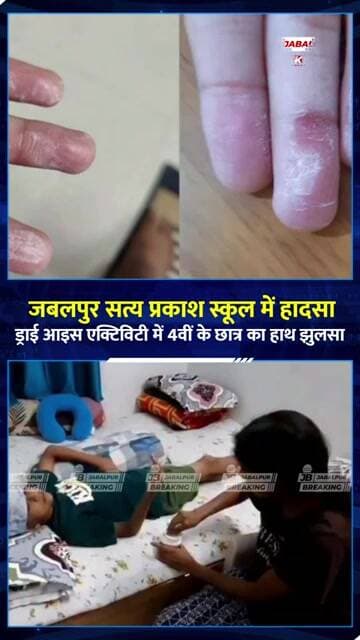 जबलपुर स्कूल में Dry Ice Activity के दौरान छात्र का हाथ झुलसा | 4 उंगलियां प्रभावित, सुरक्षा पर सवाल
