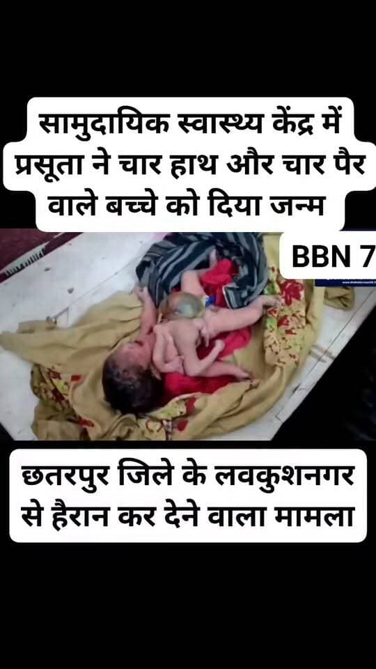 छतरपुर जिले के लवकुशनगर से हैरान कर देने वाला मामला सामने आया है। यहां सामुदायिक स्वास्थ्य केंद्र में एक महिला ने चार हाथ और चार पैर वाले बच्चे को जन्म दिया। नवजात के जन्म की खबर फैलते ही अस्पताल में उसे देखने के लिए लोगों की भीड़ जुट गई। डॉक्टरों के मुताबिक, यह मामला जुड़वां भ्रूण के अधूरे विकास से जुड़ा है। गर्भ में दो भ्रूण विकसित हो रहे थे, लेकिन चिकित्सीय जटिलता के कारण दूसरा भ्रूण पूरी तरह विकसित नहीं हो सका और उसके हाथ-पैर मुख्य बच्चे के शरीर से जुड़े रह गए। जन्म के समय बच्चे का वजन करीब 3 किलो बताया गया है। फिलहाल डॉक्टर नवजात की स्थिति पर नजर बनाए हुए हैं। अतिरिक्त अंगों को सर्जरी के जरिए अलग किया जा सकता है या नहीं, इसके लिए विशेषज्ञ डॉक्टरों की सलाह ली जा रही है। बच्चे की तस्वीरें भी सोशल मीडिया पर वायरल हो रही हैं।
#chhatarpurnews #newborn