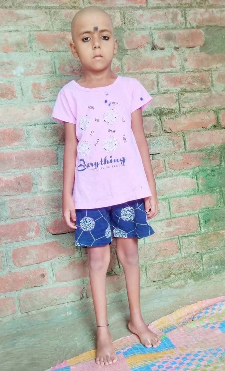 किशनगंज,महंगे इलाज ने छीन ली थी उम्मीद,आरबीएसके के निःशुल्क उपचार ने लौटाया भरोसा;अब सात वर्षीय सिफत के कदम लिखेंगे नई कहानी
किशनगंज जिला अन्तर्गत आज दिनांक 23 अगस्त 2026 को बैंकिंग न्यूज जिले में अब किसी बच्चे के कदमों में आई रुकावट केवल उसकी चाल को नहीं रोकती, बल्कि उसके पूरे भविष्य को लेकर परिवार के मन में चिंता पैदा कर देती है। सोनथा, कोचाधामन की सात वर्षीय सिफत परवीन, पिता साबिद अनवर, के परिवार ने भी ऐसी ही चिंता का सामना किया। सिफत जन्मजात रूप से मुड़े हुए पैर यानी क्लबफुट की समस्या से जूझ रही थी। परिवार की सबसे बड़ी चिंता थी कि आखिर वह कब और कैसे सामान्य बच्चों की तरह चल पाएगी।गरीब परिवार के लिए इलाज का खर्च सबसे बड़ी चुनौती था। महंगे उपचार और सर्जरी के बारे में सोचकर परिवार की उम्मीद धीरे-धीरे कमजोर पड़ने लगी थी। मां को सबसे अधिक चिंता अपनी बेटी के भविष्य की थी। मन में बार-बार यही सवाल उठता था कि अगर सिफत का पैर ठीक नहीं हुआ तो क्या वह सामान्य बच्चों की तरह चल पाएगी, स्कूल जा पाएगी, खेल पाएगी और अपने सपनों को पूरा कर पाएगी। बेटी के भविष्य की कल्पना करते ही मां का दिल कांप उठता था और पूरा परिवार चिंता में डूब जाता था।इसी बीच राष्ट्रीय बाल स्वास्थ्य कार्यक्रम (आरबीएसके) परिवार के लिए उम्मीद की नई किरण बनकर सामने आया। स्वास्थ्य विभाग की पहल से सिफत की समस्या की पहचान हुई और उसके उपचार की प्रक्रिया शुरू हुई। इसके बाद 27 मार्च 2026 को जेएलएनएमसीएच, भागलपुर में सिफत की क्लबफुट की सर्जरी कराई गई। सबसे बड़ी राहत यह रही कि उपचार और सर्जरी सरकारी योजना के तहत निःशुल्क कराई गई।
महंगे इलाज ने कमजोर कर दी थी उम्मीद, सरकारी योजना ने दिखाया रास्ता
सिफत के परिवार के लिए बेटी का इलाज कराना आसान नहीं था। शुरुआत में परिवार को यह विश्वास भी नहीं था कि सरकारी योजना के तहत इतना बड़ा उपचार पूरी तरह निःशुल्क हो सकता है। आर्थिक स्थिति को देखते हुए परिवार को लगता था कि इलाज के लिए बड़ी रकम की जरूरत पड़ेगी।लेकिन जब आरबीएसके के माध्यम से उपचार की प्रक्रिया आगे बढ़ी और बिना किसी आर्थिक बोझ के सिफत की सर्जरी कराई गई, तो परिवार का सरकारी स्वास्थ्य व्यवस्था पर भरोसा मजबूत हुआ।सिफत की मां ने भावुक होकर कहा कि शुरुआत में हमें विश्वास नहीं था कि हमारी बेटी का इतना बड़ा इलाज बिना पैसे के हो जाएगा। हमें लगता था कि इलाज के लिए बहुत खर्च करना पड़ेगा और हम इतना खर्च नहीं उठा पाएंगे। बेटी के भविष्य को लेकर हमेशा डर लगा रहता था। लेकिन जब सरकार की योजना से पूरा इलाज निःशुल्क हुआ तो हमारी खुशी का ठिकाना नहीं रहा। अब हमें गर्व होता है कि सरकार गरीब परिवारों के बच्चों के लिए इतनी बड़ी मदद कर रही है। मैं सरकार और स्वास्थ्य विभाग को दिल से धन्यवाद देती हूं। हमारी सबसे बड़ी इच्छा है कि हमारी बेटी अपने पैरों पर चले और अपने सपनों को पूरा करे।
सिफत की कहानी बताती है कि आर्थिक मजबूरी इलाज में बाधा नहीं
सिफत की कहानी केवल एक बच्चे की सर्जरी की कहानी नहीं है, बल्कि यह सरकारी स्वास्थ्य योजनाओं के उस उद्देश्य को सामने लाती है, जिसमें आर्थिक रूप से कमजोर परिवारों के बच्चों को भी बेहतर उपचार उपलब्ध कराने का प्रयास किया जा रहा है।आरबीएसके के तहत बच्चों में जन्मजात विकृति, गंभीर बीमारी, विकास संबंधी समस्या सहित विभिन्न स्वास्थ्य समस्याओं की पहचान की जाती है। जरूरत के अनुसार बच्चों को उच्च स्वास्थ्य संस्थानों में उपचार और सर्जरी के लिए भेजा जाता है। इसका उद्देश्य है कि किसी बच्चे का भविष्य केवल इसलिए प्रभावित न हो कि उसका परिवार महंगा इलाज कराने में सक्षम नहीं है।
जिले में कई बच्चों को मिला उपचार और सर्जरी का लाभ
जिले में आरबीएसके एवं बाल स्वास्थ्य से जुड़ी सरकारी योजनाओं के माध्यम से अब तक विभिन्न गंभीर और जन्मजात बीमारियों से पीड़ित बच्चों को उपचार एवं सर्जरी की सुविधा उपलब्ध कराई गई है। सिविल सर्जन डॉ राज कुमार चौधरी ने कहा कि वर्ष 2025 में क्लबफुट के 10 बच्चों का उपचार एवं सर्जरी कराई गई, जबकि वर्ष 2026 में अब तक 5 बच्चों को इसका लाभ मिल चुका है।इसी तरह जन्मजात हृदय रोग (सीएचडी) से पीड़ित बच्चों को मुख्यमंत्री बाल हृदय योजना एवं राष्ट्रीय बाल स्वास्थ्य कार्यक्रम के तहत उपचार और सर्जरी की सुविधा दी गई। वर्ष 2025 में 16 बच्चों तथा वर्ष 2026 में अब तक 6 बच्चों की सर्जरी कराई जा चुकी है।बाल श्रवण योजना के तहत वर्ष 2025 में 2 बच्चों और वर्ष 2026 में अब तक 1 बच्चे को सर्जरी का लाभ मिला है। वहीं कटे होंठ एवं तालू की समस्या से पीड़ित बच्चों में वर्ष 2025 में 2 और वर्ष 2026 में अब तक 1 बच्चे की सर्जरी कराई गई है।इसके अलावा वर्ष 2025 में न्यूरल ट्यूब डिफेक्ट से पीड़ित 2 बच्चों को भी उपचार एवं सर्जरी की सुविधा उपलब्ध कराई गई।
बच्चे के भविष्य में आर्थिक स्थिति बाधा न बने
जिला पदाधिकारी नवीन कुमार ने कहा कि बच्चों का स्वस्थ जीवन उनके बेहतर भविष्य की पहली सीढ़ी है। सरकार की योजनाओं का उद्देश्य यह सुनिश्चित करना है कि आर्थिक रूप से कमजोर परिवारों के बच्चों को भी समय पर आवश्यक उपचार और विशेषज्ञ स्वास्थ्य सेवाएं मिल सकें।उन्होंने कहा कि किसी बच्चे की बीमारी या परिवार की आर्थिक स्थिति उसके भविष्य की राह में बाधा नहीं बननी चाहिए। सरकार की योजनाओं के माध्यम से बच्चों की समय पर पहचान, उपचार और आवश्यकतानुसार सर्जरी सुनिश्चित की जा रही है। अभिभावकों को बच्चों में दिखाई देने वाली किसी भी जन्मजात समस्या या स्वास्थ्य संबंधी परेशानी को नजरअंदाज नहीं करना चाहिए और समय पर स्वास्थ्य संस्थान से संपर्क करना चाहिए।उन्होंने कहा कि योजनाओं का वास्तविक लाभ तभी सुनिश्चित होगा, जब जरूरतमंद परिवार जागरूक होकर स्वास्थ्य सेवाओं का लाभ उठाएं।
समय पर पहचान और उपचार से बदल सकता है भविष्य
सिविल सर्जन ने कहा कि आरबीएसके बच्चों की स्वास्थ्य समस्याओं की समय पर पहचान और उनके समुचित उपचार की दिशा में महत्वपूर्ण कार्यक्रम है। स्वास्थ्य विभाग का प्रयास है कि चिन्हित बच्चों को जांच से लेकर आवश्यक उपचार और सर्जरी तक की सुविधा उपलब्ध हो।उन्होंने कहा कि सिफत जैसे बच्चों का सफल उपचार यह दिखाता है कि सरकारी स्वास्थ्य योजनाएं जरूरतमंद परिवारों के लिए कितनी महत्वपूर्ण हैं। किसी बच्चे में जन्मजात विकृति या अन्य गंभीर स्वास्थ्य समस्या दिखाई दे तो परिवार को इसे छिपाने या टालने के बजाय स्वास्थ्य टीम से संपर्क करना चाहिए। समय पर पहचान और उपचार से बच्चे को बेहतर और सामान्य जीवन की ओर लौटने का अवसर मिलता है।
अब सिफत के कदमों में डर नहीं, भविष्य की उम्मीद है
जिस परिवार को कभी महंगे इलाज की चिंता के कारण बेटी के भविष्य की राह धुंधली नजर आती थी, आज उसी परिवार को सिफत के कदमों में नई उम्मीद दिखाई दे रही है। आरबीएसके ने सिफत को केवल निःशुल्क उपचार उपलब्ध नहीं कराया, बल्कि उसके परिवार को यह विश्वास भी दिया कि आर्थिक कमजोरी उसके सपनों की राह में दीवार नहीं बनेगी।सिफत की कहानी उन हजारों परिवारों के लिए संदेश है, जो आर्थिक कारणों से अपने बच्चों के इलाज को लेकर चिंतित रहते हैं। सरकारी स्वास्थ्य योजनाएं उनके लिए सहारा बन सकती हैं। जरूरत है कि बच्चे की समस्या की समय पर पहचान हो और परिवार बिना झिझक स्वास्थ्य व्यवस्था से जुड़े।कभी जिन कदमों के रुक जाने का डर था, उन्हीं कदमों में अब आगे बढ़ने की उम्मीद है। सिफत की यह नई शुरुआत केवल उसके परिवार की खुशी नहीं, बल्कि उस सरकारी व्यवस्था की सफलता की कहानी भी है, जिसका उद्देश्य है—हर बच्चे को स्वस्थ बचपन और अपने सपनों तक पहुंचने का समान अवसर देना। #viralpost #viralreelschallenge #viralchallenge #videogames #vacaciones #Venezuela #viralreels #2026Goals #newyork