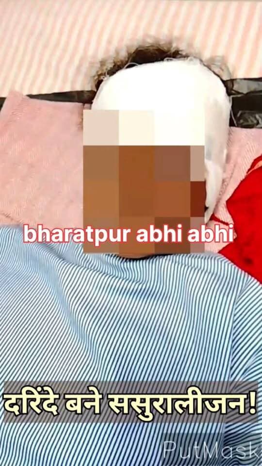 #ऐसे_दरिंदो_को_बक्शा_नहीं_जाए!
भरतपुर। डीग जिले के जालूकी थाने के गांव गहनकर में बेरहम ससुरालीजनों ने अपनी बहु बबीता का पीट पीटकर ऐसा हाल कर दिया है कि उसका चेहरा और शरीर को देखकर हर किसी की रूह कांप जाए। आरोप है कि बबीता को धारधार हथियार और लाठियों से इतना पीटा गया है कि उसका चेहरा दिखाया भी नहीं जा सकता। बबीता के भाई सुनील के अनुसार, बहन के आंख, कान, सिर, चेहरे और अंदरूनी अंगों में गंभीर चोटें आई हैं। अभी अलवर के प्राइवेट हॉस्पिटल में इलाज जारी है।