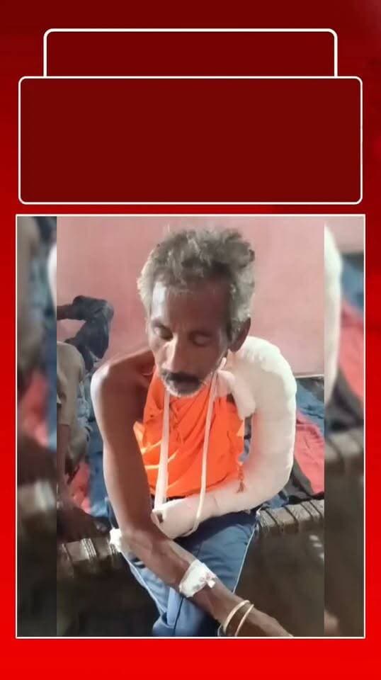 मानसिक रूप से कमजोर व्यक्ति से मारपीट, हाथ टूटने का आरोप चार लोगों के खिलाफ कार्रवाई की मांग