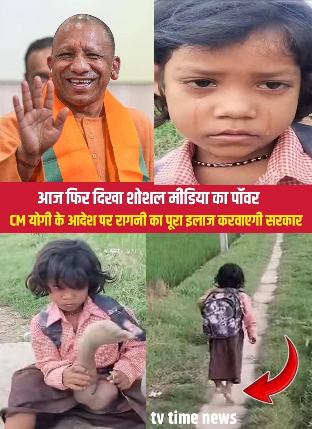 वायरल 07 साल की रागनी की पुकार CM योगी तक पहुंची CM योगी का बड़ा आदेश 💪💪
रागिनी ने 31 अगस्त को बलिया के डीएम से स्कूल जाने के लिए साइकिल की मांग की थी। उसकी सबसे बड़ी इच्छा थी कि वह नियमित रूप से स्कूल जाए और खूब पढ़े। उसकी यह अपील सोशल मीडिया पर वायरल हुई और मामला मुख्यमंत्री योगी आदित्यनाथ तक पहुंच गया।
मुख्यमंत्री के निर्देश के बाद जिला प्रशासन तुरंत सक्रिय हुआ। डीएम मंगला प्रसाद सिंह रागिनी के गांव पहुंचे और उसे दो ट्राइसाइकिल के साथ पढ़ाई का जरूरी सामान उपलब्ध कराया। ट्राइसाइकिल मिलने के बाद रागिनी ने मासूमियत से कहा कि अब उसे और कुछ नहीं चाहिए।
लेकिन मुख्यमंत्री के निर्देश पर मदद यहीं नहीं रुकी। अब रागिनी के इलाज की पूरी जिम्मेदारी भी प्रदेश सरकार उठाएगी। जिला अस्पताल में डॉक्टरों ने उसकी जांच की। बचपन में पैर में हुए फ्रैक्चर के बाद हड्डी ठीक तरह से न जुड़ पाने की वजह से पैर की स्थिति बिगड़ गई थी।
जिला स्तर पर जरूरी विशेष जांच की सुविधा उपलब्ध नहीं होने के कारण रागिनी को BHU, वाराणसी भेजने का फैसला लिया गया है। वहां विशेषज्ञ डॉक्टर उसकी नसों और पैर की स्थिति की विस्तृत जांच करेंगे। जांच रिपोर्ट के आधार पर आगे ऑपरेशन या अन्य उचित उपचार का फैसला लिया जाएगा।
एक पैर की परेशानी रागिनी के कदम रोक सकती है, लेकिन पढ़ने का उसका हौसला नहीं। मुख्यमंत्री के निर्देश के बाद अब उसकी पढ़ाई के साथ-साथ बेहतर इलाज की उम्मीद भी जगी है।
<nis:link nis:type=tag nis:id=cmyogi nis:value=CMYogi nis:enabled=true nis:link/> <nis:link nis:type=tag nis:id=ragini nis:value=Ragini nis:enabled=true nis:link/> <nis:link nis:type=tag nis:id=upnews nis:value=UPNews nis:enabled=true nis:link/> <nis:link nis:type=tag nis:id=ballianews nis:value=BalliaNews nis:enabled=true nis:link/> <nis:link nis:type=tag nis:id=viralnews nis:value=viralnews nis:enabled=true nis:link/>