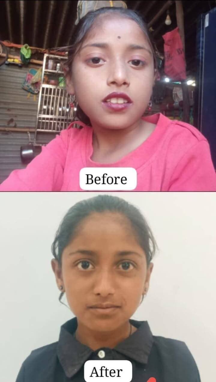 *सफलता की कहानी*
*आरबीएसके टीम द्वारा समय पर पहचान, उपचार और सहयोग से मिला स्वस्थ जीवन का उपहार*
बड़वानी 6 सितंबर 2026/वैशाली, पिता श्री कासिया भूरिया एवं माता श्रीमती राधा, उम्र 12 वर्ष, निवासी बड़गांव सिलावद, जिला बड़वानी, एक मजदूर परिवार से हैं। माता-पिता मजदूरी कर परिवार का पालन-पोषण करते हैं। वर्तमान में वैशाली शासकीय छात्रावास सिलावद में रहकर अपनी पढ़ाई कर रही है।
राष्ट्रीय बाल स्वास्थ्य कार्यक्रम (RBSK) के अंतर्गत RBSK AMO डॉ. मोनिका गुप्ता एवं डॉ. रवि सावले द्वारा की गई स्क्रीनिंग में वैशाली के हृदय में छेद होने की जानकारी सामने आई। परिवार के लिए यह चिंता का विषय था, लेकिन समय पर हुई पहचान ने उपचार की राह आसान कर दी।
इसके बाद 21 जनवरी 2026 को जिला शीघ्र हस्तक्षेप केंद्र (DEIC) में आयोजित शिविर में अरविंद हॉस्पिटल, इंदौर के कार्डियोलॉजिस्ट द्वारा बच्ची ईको जांच की गई। जांच के बाद 21मई 2026 को आयुष्मान भारत योजना के अंतर्गत वैशाली की निःशुल्क हृदय सर्जरी की गई।
सर्जरी के बाद अरविंद हॉस्पिटल, इंदौर में पहला फॉलोअप सफलतापूर्वक हुआ। इसके पश्चात जिला चिकित्सालय के शिशु रोग विशेषज्ञ डॉ. जे.सी. मालवीय द्वारा 5 सितम्बर 2026 को दूसरा फॉलोअप किया गया। आज वैशाली पूरी तरह स्वस्थ है और अपनी पढ़ाई जारी रख रही है।
वैशाली के स्वस्थ होने से उसके माता-पिता के चेहरे पर खुशी लौट आई। उन्होंने कलेक्टर महोदया जिला बड़वानी, मुख्य चिकित्सा एवं स्वास्थ्य अधिकारी, RBSK टीम एवं DEIC टीम के प्रति आभार व्यक्त किया।
“समय पर पहचान, सही उपचार और सरकारी योजना का लाभ—बच्चों के स्वस्थ भविष्य की मजबूत नींव है।”