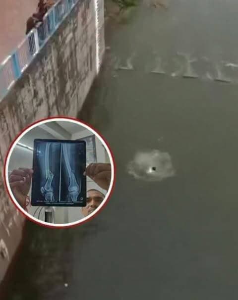 सावधान.....
30 फीट से लगाई छलांग, दोनों पैर फ्रैक्चर।
दैनिक वीरधरा राजस्थान।
झांसी। पहूज बांध पर रील बनाने के चक्कर में युवक ने करीब 30 फीट ऊंचाई से छलांग लगा दी। कम पानी होने के कारण वह नीचे चट्टान से टकरा गया, जिससे उसके दोनों पैर फ्रैक्चर हो गए। हादसे के वक्त दोस्त वीडियो बना रहे थे। एक पैर में दो रॉड डाली गई हैं, जबकि दूसरे का ऑपरेशन होना बाकी है। हादसे का वीडियो सोशल मीडिया पर वायरल है।