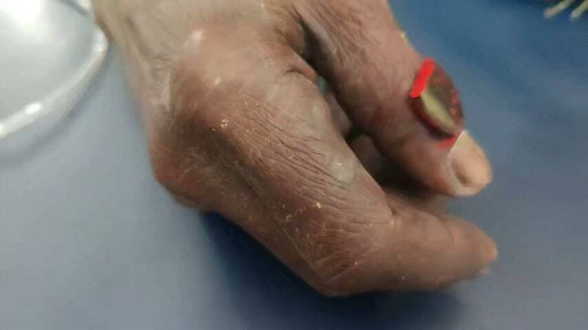 अब भी लोग सांप काटने पर घरेलू इलाज फिर अस्पताल