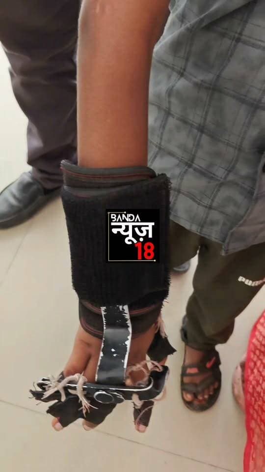 बांदा:-इलाज के नाम पर ₹20 हजार लेने का आरोप,डॉक्टर पर बच्चे के हाथ का गलत ऑपरेशन करने का आरोप,पीड़ित महिला ने एसपी डीएम से लगाई न्याय की गुहार,बिसंडा थाना क्षेत्र की महिला ने पुलिस अधीक्षक को शिकायती पत्र देकर डॉक्टर पर गंभीर आरोप लगाए।महिला के अनुसार उसके नाबालिग पुत्र के हाथ में चोट लगने के बाद जिला अस्पताल में इलाज कराया गया।आरोप है कि ऑपरेशन के नाम पर ₹20 हजार रुपये लिए गए और ऑपरेशन के बाद बच्चे के हाथ में परेशानी बढ़ गई।शिकायतकर्ता का आरोप है कि बच्चे का दाहिना हाथ कथित रूप से ठीक से काम नहीं कर रहा है।शिकायती पत्र में डॉक्टर पर अभद्र भाषा और जातिसूचक शब्दों के इस्तेमाल का भी आरोप लगाया गया है।पीड़ित महिला ने मामले की जांच कर दोषी के खिलाफ कानूनी कार्रवाई की मांग की है।अब देखना होगा कि शिकायत पर पुलिस और स्वास्थ्य विभाग क्या कार्रवाई करता है।