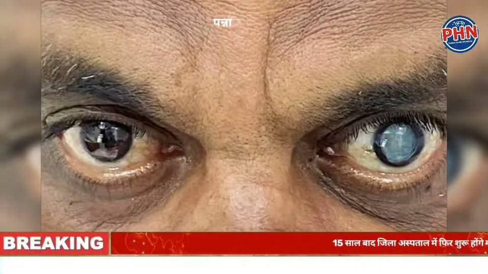 15 साल बाद जिला अस्पताल में फिर शुरू होंगे मोतियाबिंद के ऑपरेशन, 34 लाख से ऑपरेशन थियेटर तैयार, चित्रकूट-सतना सहित दूसरे शहरों की दौड़ से मिलेगी मुक्ति