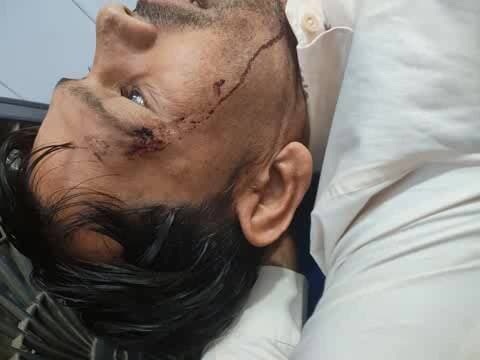 चंदेरी: पुरानी रंजिश में युवक पर फावड़े से हमला, चंदेरी पुलिस ने FIR दर्ज की