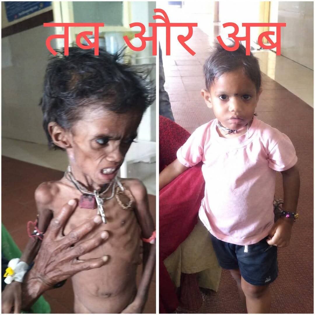 साझा प्रयासों से लौटी चेहरे पर मुस्कान, स्वस्थ हुआ कान्हा
कलेक्टर ने तत्समय एम्स प्रबंधन से बात कर उपचार के लिए कराया था शिफ्ट
----
कलेक्टर सुश्री शीला दाहिमा के विशेष प्रयासों और स्वास्थ्य तथा महिला बाल विकास विभाग के समन्वय से दो वर्षीय आदिवासी बालक कान्हा के चेहरे पर न केवल मुस्कान लौट आई है, बल्कि उसके परिजनों के चेहरो पर भी सुकून दिखाई पड रहा है। यह वहीं बालक कान्हा आदिवासी है, जिसे कलेक्टर सुश्री शीला दाहिमा द्वारा एम्स प्रबंधन से चर्चा कर उसे बेहतर इलाज के लिए सितंबर माह में भोपाल शिफ्ट किया गया था। प्रशासन सहित स्वास्थ्य एवं महिला बाल विकास विभाग और एम्स प्रबंधन भोपाल के साझा प्रयासों से कान्हा को स्वस्थ जीवन मिला है।
गत 16 अक्टूबर 2026 को श्योपुर एनआरसी में आंगनबाडी कार्यकर्ता के साथ फॉलोअप के लिए आये कान्हा का वजन अब 6 किलो 600 ग्राम हो गया है और वह पूरी तरह से स्वस्थ है। बता दे कि कान्हा आदिवासी पिता श्री मंगल आदिवासी को महिला बाल विकास विभाग द्वारा स्वास्थ्य लाभ के लिए एनआरसी श्योपुर लाया गया था, चिकित्सको की टीम द्वारा बालक का एनआरसी प्रोटोकॉल अनुसार उपचार किया जा रहा था, लेकिन बालक का वजन नही बढने से श्योपुर की चिकित्सकीय टीम द्वारा जांच एवं परीक्षण में बालक को किसी प्रकार की जन्मजात मेटाबोलिक विकृति होने की संभावना व्यक्त की गई थी तथा उच्च मेडिकल संस्थान में परीक्षण के लिए परामर्श दिया गया था।
इस मामले में कलेक्टर सुश्री शीला दाहिमा द्वारा मानवीय दृष्टिकोण के साथ एम्स भोपाल के प्रबंधन से इस संबंध में चर्चा करने के बाद बालक की सकुशल शिफ्टिंग के निर्देश स्वास्थ्य विभाग एवं महिला बाल विकास विभाग के अधिकारियों को दिये गये थे। उक्त निर्देशो के क्रम में लाइफ सपोर्ट एम्बुलेंस के माध्यम से स्वास्थ्य दल की निगरानी में बालक को 11 सितंबर को एम्स भोपाल में बेहतर उपचार के लिए शिफ्ट किया गया था।
आंगनबाडी कार्यकर्ता श्रीमती रूकमणी भी बच्चें और उसके परिजनों के साथ एम्स भोपाल में ही रहीं और निरंतर निगरानी के साथ ही श्योपुर में अधिकारियों के साथ उचित समन्वय के लिए कार्य करती रहीं, उनकी भूमिका भी प्रशंसनीय है। एम्स भोपाल में निरंतर उपचार के उपरांत बालक के पूरी तरह स्वस्थ होने के बाद उसे वापस अपने गांव कलमी लाया गया और आंगनबाडी कार्यकर्ता एवं सुपरवाईजर की निरंतर गृह भेंट के माध्यम से उसके पोषण तथा स्वास्थ्य पर नजर रखते हुए चिकित्सीय परामर्श अनुसार दवाईयां प्रदान की गई। वर्तमान में बालक पूरी तरह से स्वस्थ हो गया है। गत 16 अक्टूबर को उसे एनआरसी श्योपुर में फॉलोअप के लिए लाया गया, जहां उसके वजन और लम्बाई के साथ ही पोषण स्वास्थ्य से संबंधित विभिन्न पैमानों पर जांच की गई, अब बालक का वजन बढकर 6 किलो 600 ग्राम हो गया है, जबकि गत 25 अगस्त को एनआरसी लाये जाने पर बालक का वजन 4.800 ग्राम था।
इस प्रकार सभी के साझा प्रयासों और मानवीय दृष्टिकोण के साथ किये गये कार्य को सफलता मिली है और बालक कान्हा न केवल पूरी तरह से स्वस्थ है, बल्कि आम बच्चों की तरह वह भी घर-आंगन में खेल रहा है।
<nis:link nis:type=tag nis:id=jansamparmp nis:value=JansamparMP nis:enabled=true nis:link/>
<nis:link nis:type=tag nis:id=sheopur nis:value=sheopur nis:enabled=true nis:link/>