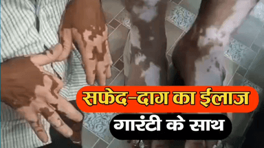 गया टाउन सीडी ब्लॉक: सिवान जिले के काव्या हॉस्पिटल में सफेद दाग का गारंटी के साथ हो रहा है ईलाज, दवा का असर नहीं तो पैसा वापस | 9835730266