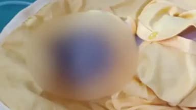 शाहगंज: शाहगंज के निजी अस्पताल में साइक्लोपिया सिंड्रोम से ग्रसित शिशु का हुआ जन्म