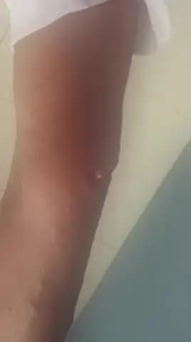 ಮಸ್ಕಿ: ಮಸ್ಕಿ ಪಟ್ಟಣದಲ್ಲಿ ಹತ್ತಕ್ಕೂ ಹೆಚ್ಚು ಬಾಲಕರ ಮೇಲೆ ದಾಳಿ ಮಾಡಿದ ಹುಚ್ಚು ನಾಯಿ