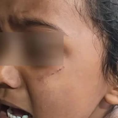 ಚಿತ್ತಾಪುರ: ಲಾಡ್ಲಾಪುರ ಗ್ರಾಮದಲ್ಲಿ ಹುಚ್ಚು ನಾಯಿಗಳ ದಾಳಿ: ನಾಲ್ವರು ಮಕ್ಕಳು ಗಂಭೀರ ಗಾಯ