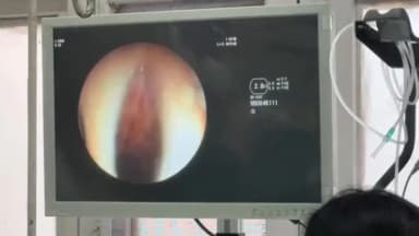 शिमला शहरी: शिमला के आईजीएमसी में अनोखा मामला, मरीज के गले से निकाली गई जीवित जोंक